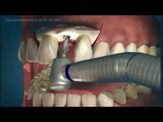 dental implantation operation (roller diagram)